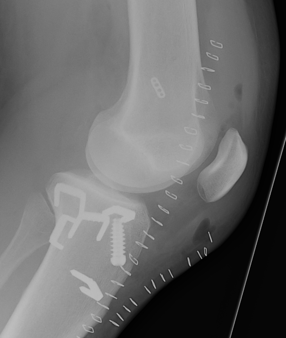 Hamstring ACL PLC Advancement Lateral